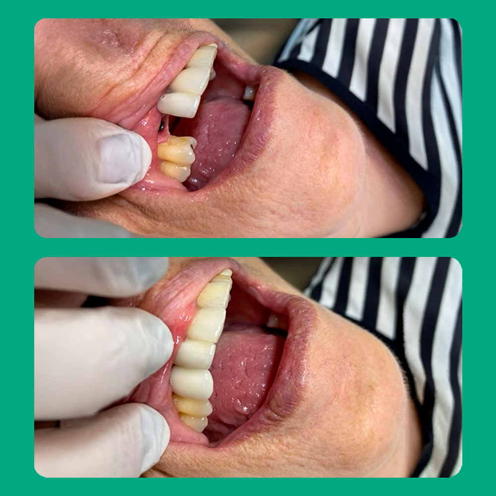 Antes e depois de tratamento odontológico 1