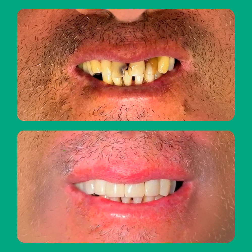 Antes e depois de tratamento odontológico 2
